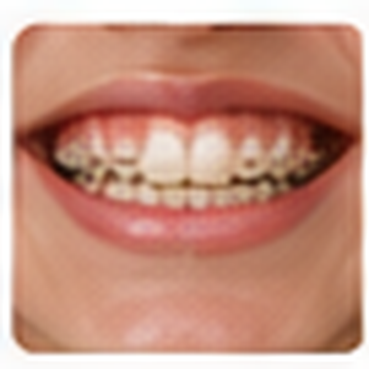 AI-generated braces before photo