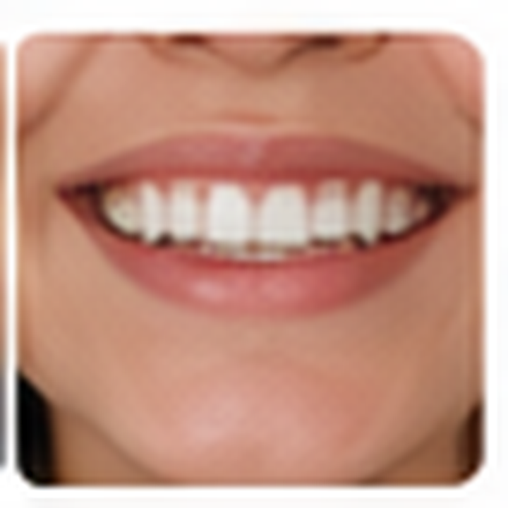 AI-generated smile design after photo