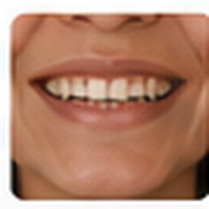 AI-generated smile design before photo